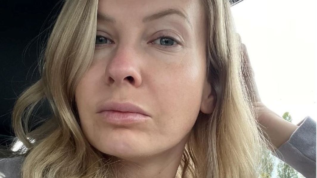 Edyta Pazura zmaga się z trądzikiem 