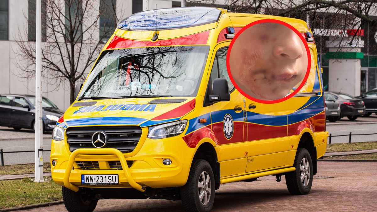 6-letni Gracjan zaatakowany przez psa (fragment zdjęcia rozmyty z uwagi na drastyczny widok)