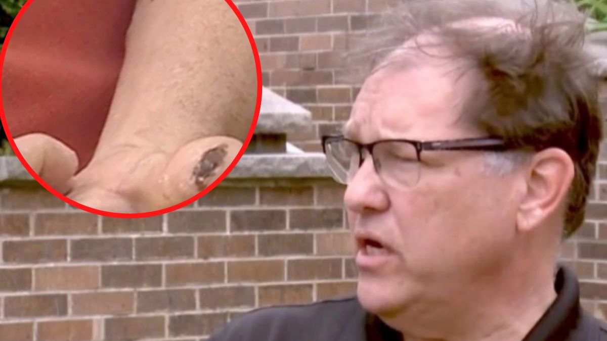 Dr Zaeske na małpią ospę zachorował po kontakcie z pieskiem preriowym