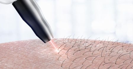 Hipertrichoza – przyczyny, objawy, diagnostyka i leczenie