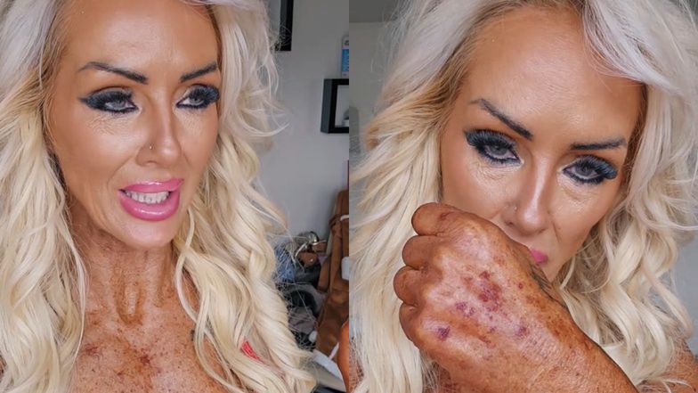 54-latka chodziła do solarium przez ponad połowę swojego życia