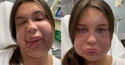 Tiktokerka powiększyła usta i trafiła do SZPITALA. Internauci: "Przypominasz DZIOBAKA" (ZDJĘCIA)
