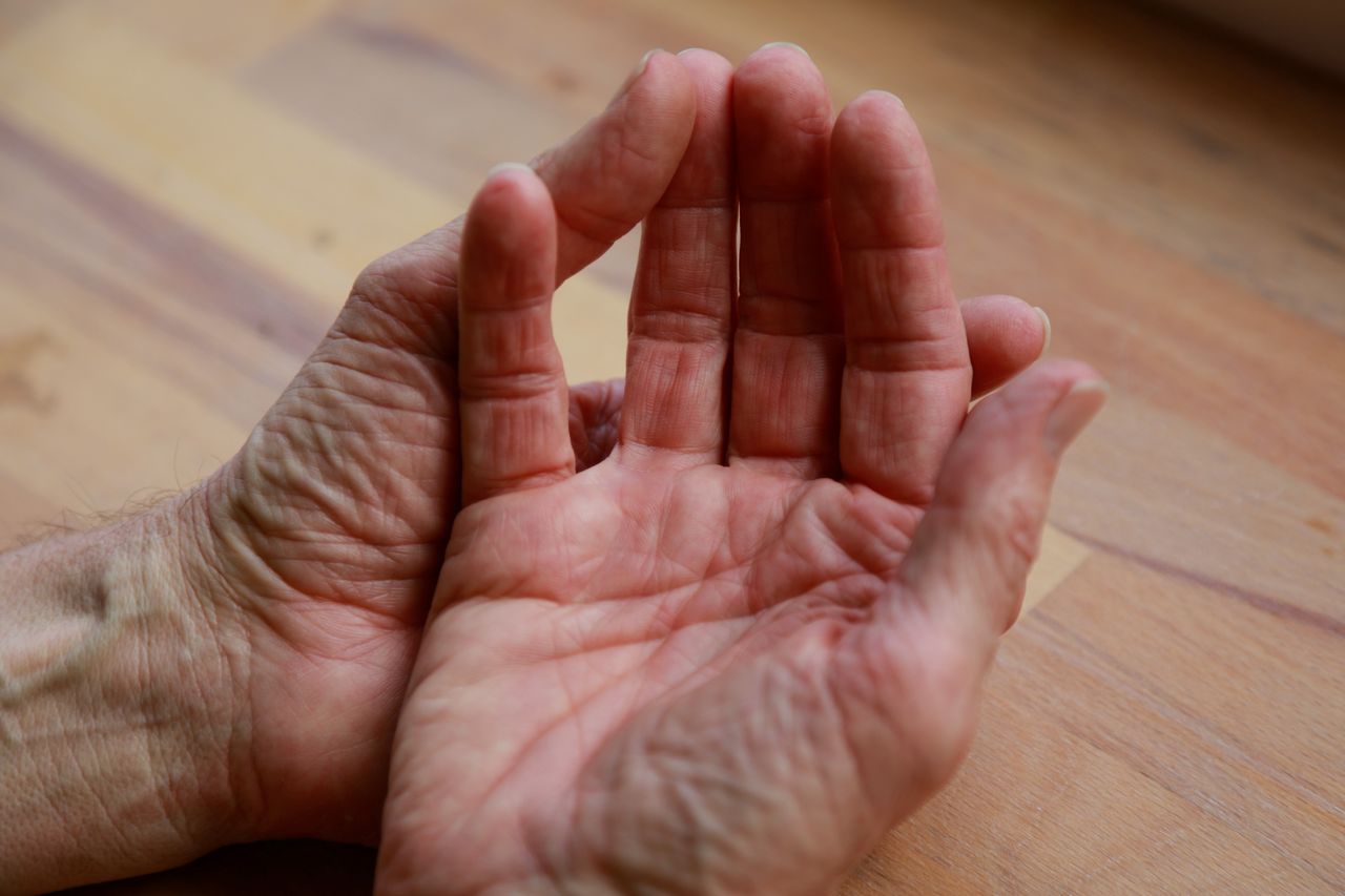 Trigger finger, a startling indicator of diabetes