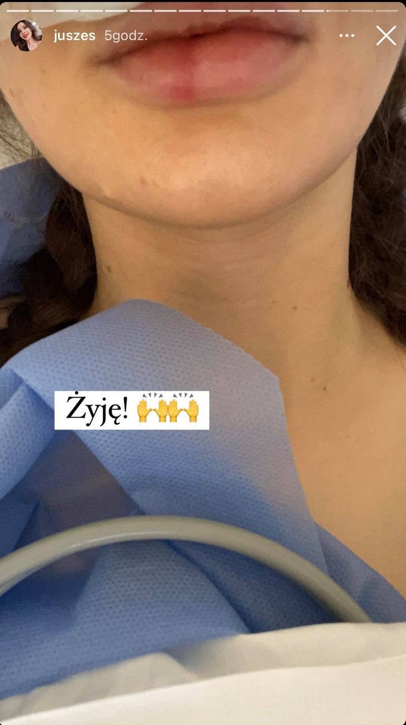 Justyna z "Big Brothera" przeszła operację plastyczną nosa