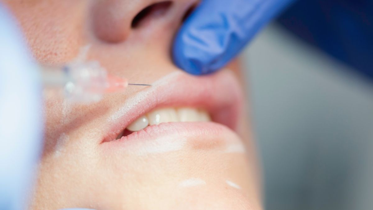 Migracja kwasu jest jednym z niepożądanych efektów związanych z modelowaniem ust kwasem hialuronowym.