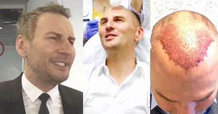 Gojdź chwali się efektami przeszczepu włosów. "Rewelacyjny efekt. Jest bujna czupryna!"