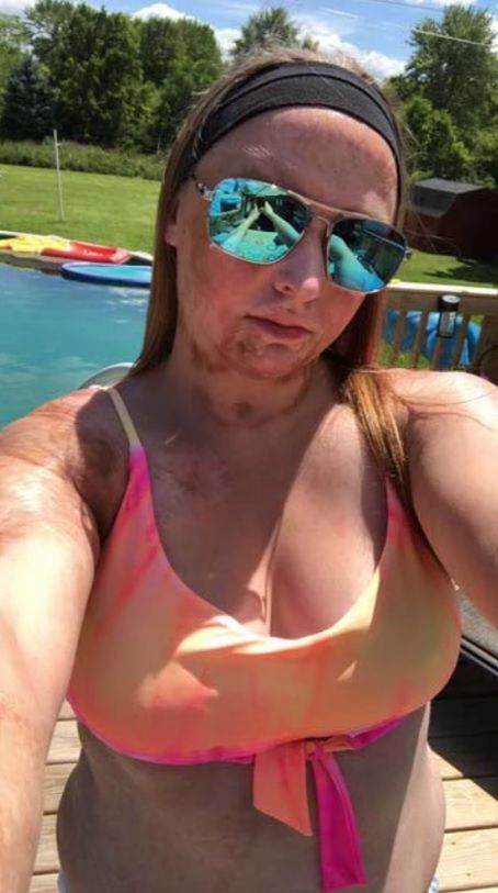 Kobieta zaakceptowała swoje blizny