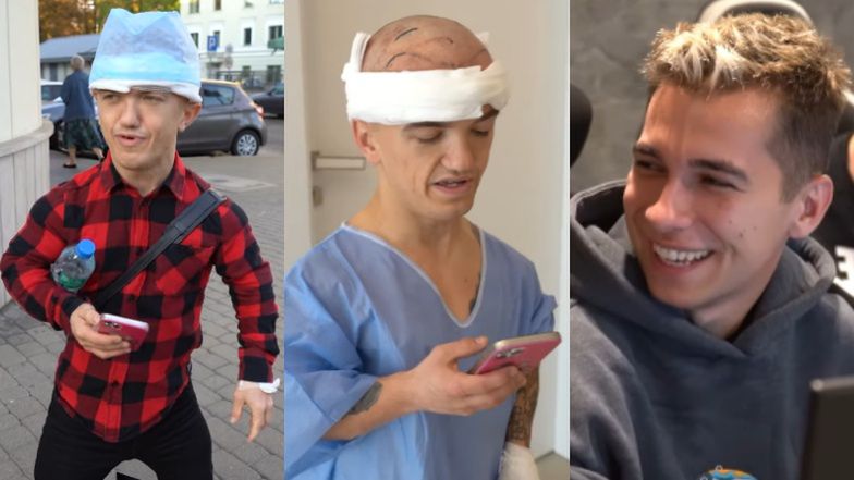 Mini Majk relacjonuje przeszczep włosów