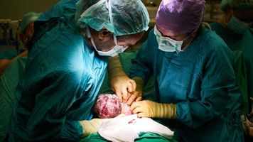 Elective C-sections?