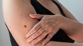 Nigdy tego nie rób! Lekarka ujawnia, jakie mogą być skutki usuwania pieprzyków w domu