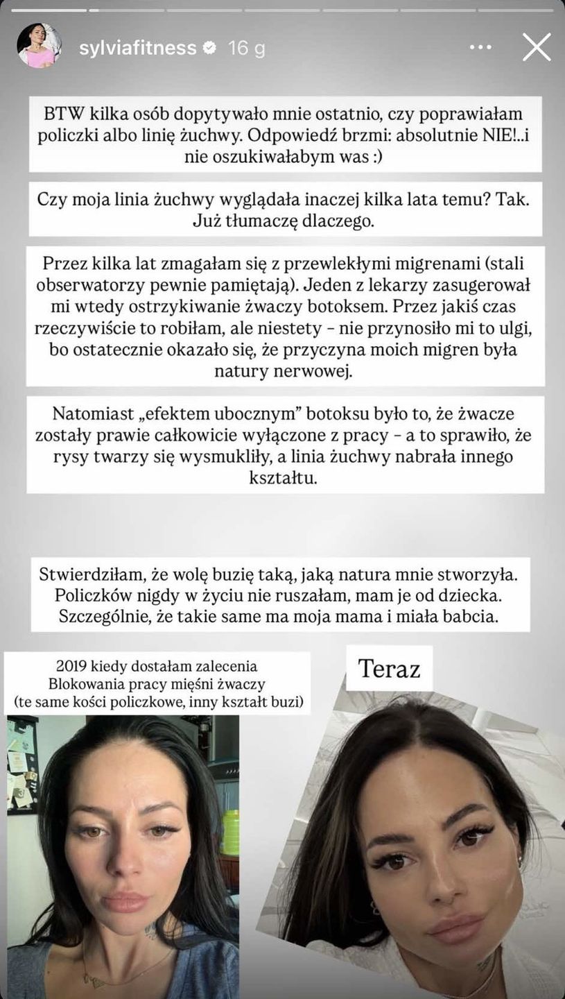 Sylwia Szostak opowiada o tym, jak botoks zmienił jej twarz