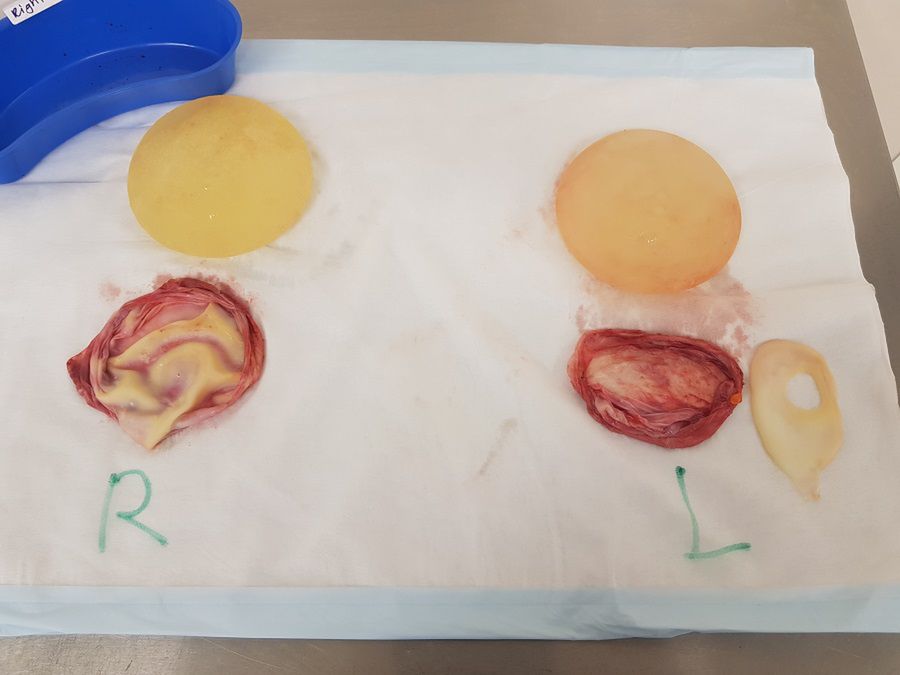 Po wyjęciu implanty wyglądały przerażająco