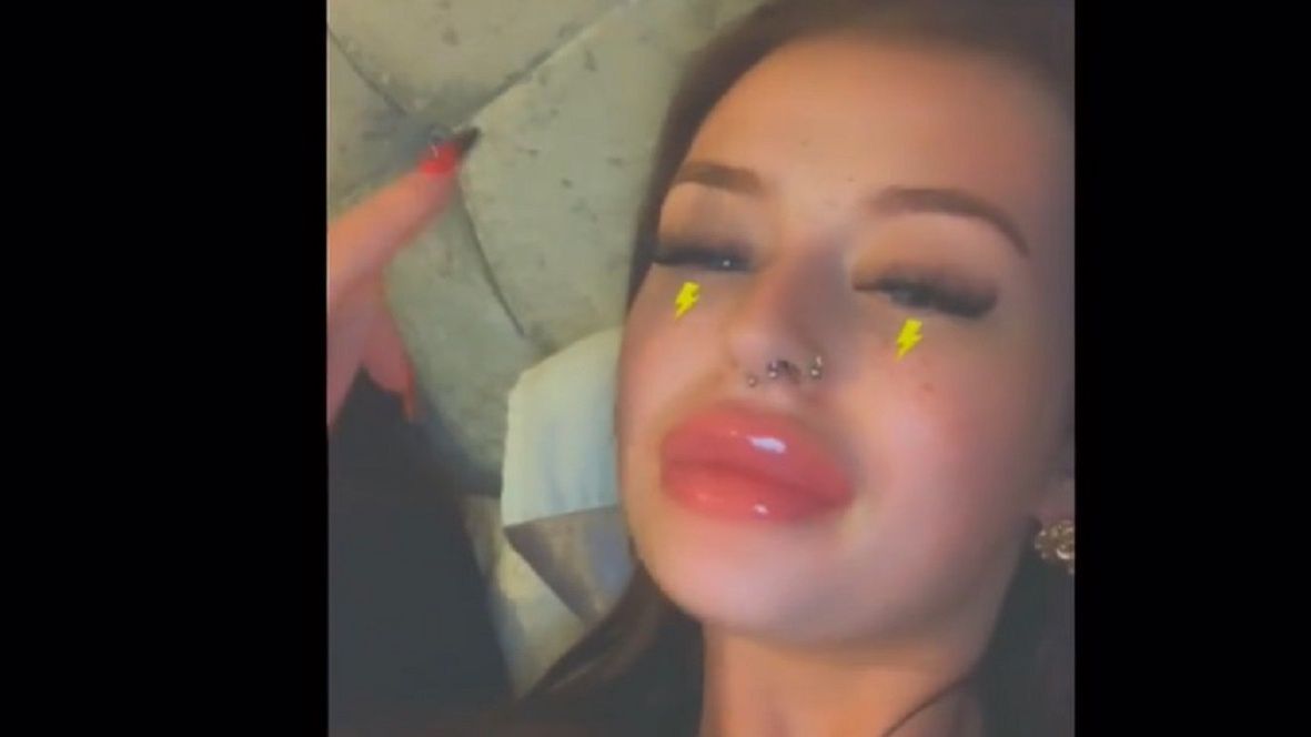 Zrobiła sobie usta. Ludzie porównali ją do kaczki. 