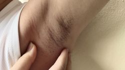 Zwróć uwagę na swoje pachy. W niektórych przypadkach może to być objaw nowotworu