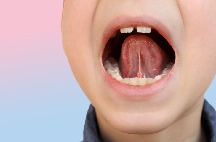 Owrzodzenie jamy ustnej to otwarta rana na błonie śluzowej, która powstaje np. wskutek urazu.
