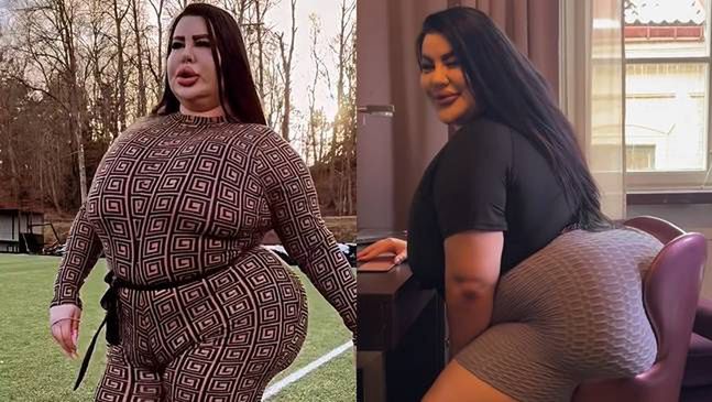 Swedish woman spends a fortune to achieve world's largest buttocks