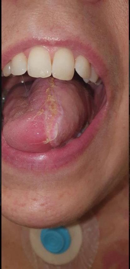 Język Annabel po przeszczepie