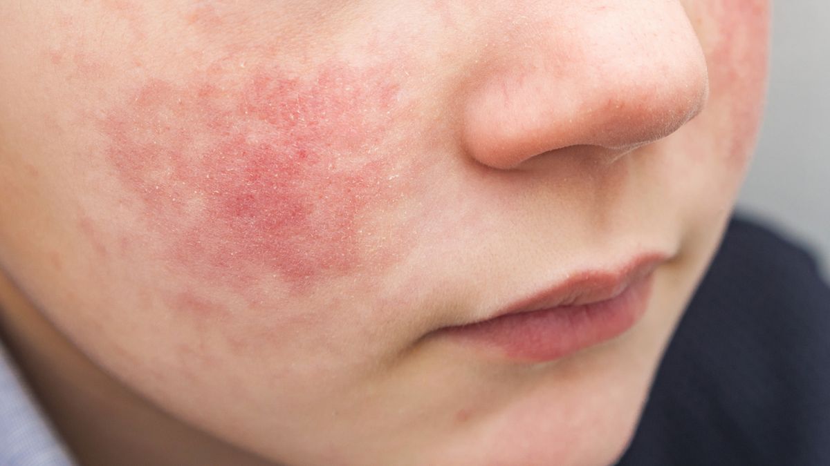 Egzema objawia się charakterystycznymi zmianami skórnymi