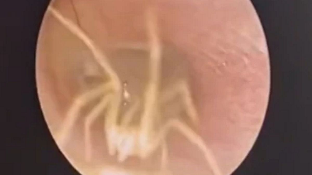  Badanie wykazało, że w uchu kobiety znajduje się... pająk.  