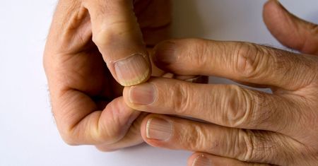 Łamliwe, rowkowane paznokcie. Który niedobór widać na nich najwcześniej?