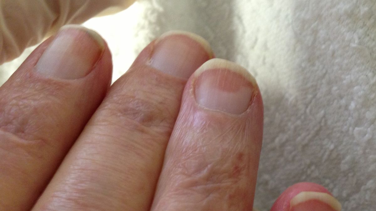 Paznokcie Terry’ego– zmiany płytki paznokciowej