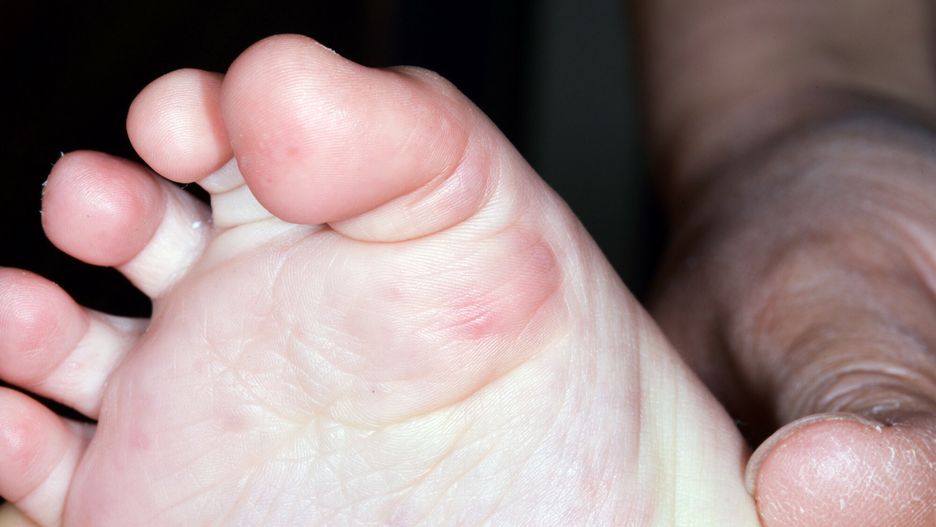 SPL RM HDHand foot and mouth disease. Close-up of a blisters on the foot of a 3-year-old girl with hand foot and mouth disease (HFMD). HFMD is caused by intestinal viruses of the picornaviridae family. The most common strains causing HFMD being coxsackie A virus A16 and enterovirus 71 (EF-71).DR P. MARAZZI