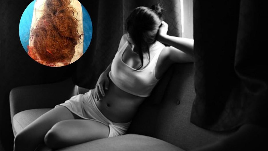 Lekarz pokazał, jak wygląda potworniak, guz jajnika najczęściej dotykający kobiety w ciąży
