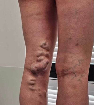 Żylaki u 27-letniej pacjentki