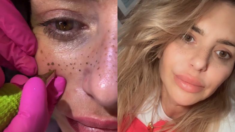 Monika Goździalska zdecydowała się na piegi permanentne