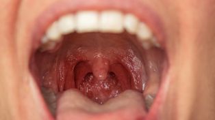 Masz nieświeży oddech? Winne mogą być kamienie migdałkowe