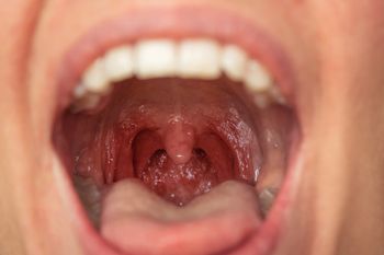 Masz nieświeży oddech? Winne mogą być kamienie migdałkowe