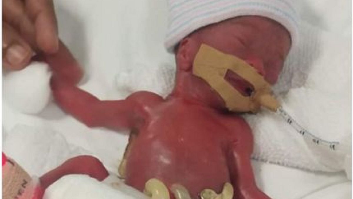 Najmniejszy noworodek świata opuścił szpital 