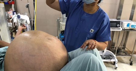 Największy guz jajnika na świecie. Ważył 50 kg