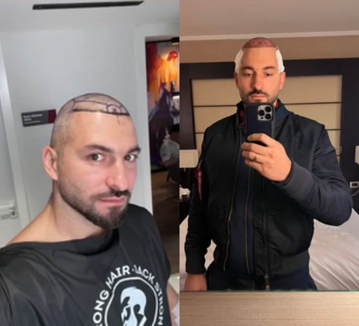 Rafał Maślak poddał się zabiegowi przeszczepu włosów