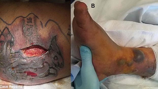 Zbagatelizował ostrzeżenia i poszedł się kąpać. Dwa miesiące później zmarł