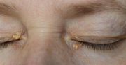 Żółte grudki na powiekach. Badanie obaliło mit