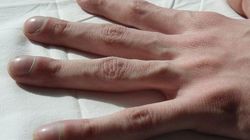 Palce pałeczkowate są objawem choroby. Nie tylko raka płuc (WIDEO)