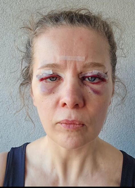 Anna Powierza wycięła sobie nadmiar powiek