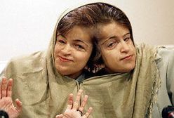 Obie siostry syjamskie nie żyją