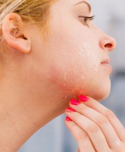 Podrażniona skóra twarzy – jak ją pielęgnować?