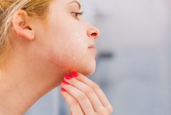 Łuszcząca się skóra – o jakich chorobach może świadczyć?