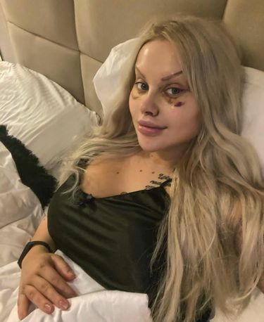 Ewelina Kubiak po operacji nosa