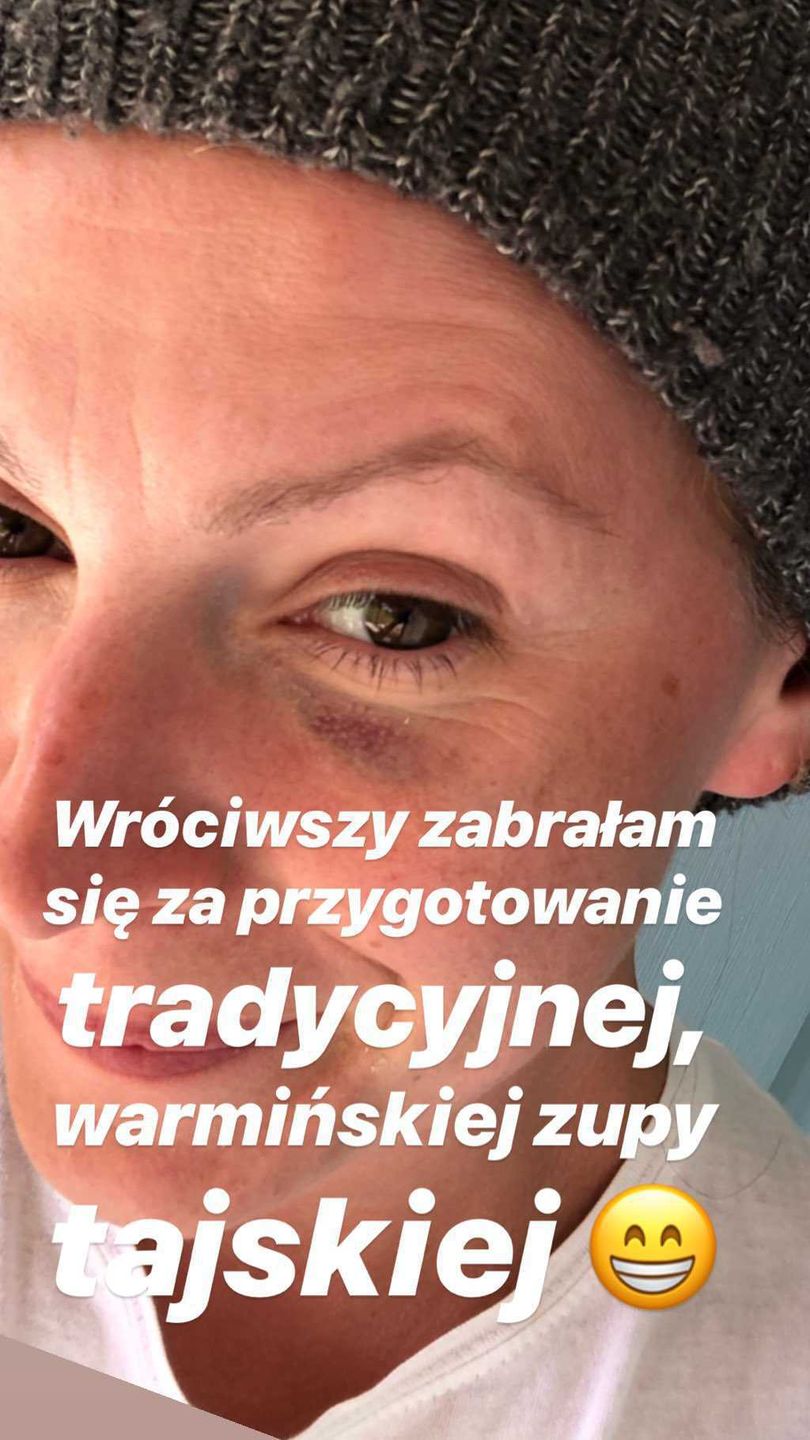 Dorota Szelągowska z podbitym okiem