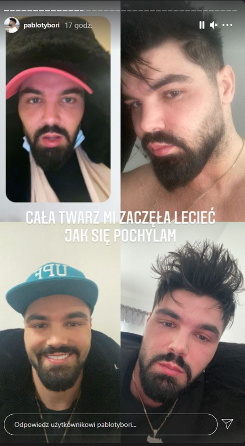 Paweł Tyburski oszpecony zabiegami