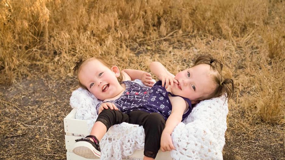 Bliźniaczki syjamskie Callie i Carter mają prawie 2 latka