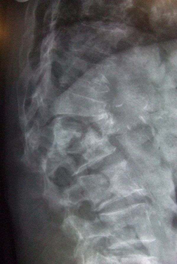 Zdjęcie RTG obrazujące zmiany związane z osteoporozą 