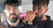 Oszpecony przez zabiegi medycyny estetycznej Paweł Tyburski z "Love Island" pokazał nową twarz. Tak teraz wygląda