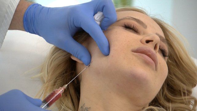 Sablewska w "Klinice urody" poddała się wampirzemu liftingowi