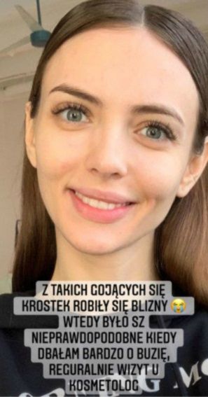 Marcela Leszczak pokazała blizny po trądziku