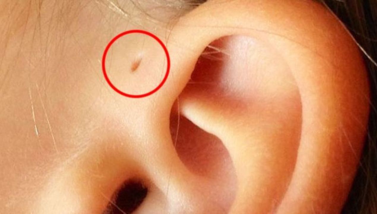 Dziurka nad uchem. Tylko 1% ludzi należy do tego wyjątkowego grona